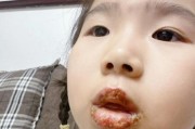 宝宝嘴巴边上长水泡怎么回事_怎么处理