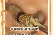 梦到扣耳屎是什么意思_梦见掏耳朵预示什么