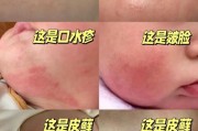 宝宝过敏图片_如何辨别食物过敏还是湿疹