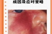 宝宝脸上红色胎记怎么去除_宝宝红色胎记会自己消失吗