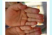 2岁宝宝手指脱皮是怎么回事_手指脱皮缺什么维生素