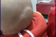 宝宝头后面骨头突出来正常吗_宝宝后脑勺骨头突出怎么办