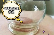 一岁宝宝能不能拔气罐_婴儿拔气罐安全吗