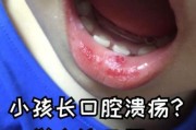 宝宝嘴巴里长溃疡怎么办_婴儿口腔溃疡快速止痛