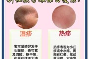 宝宝湿疹过敏源有哪些_如何快速排查