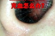 宝宝鼻子里面红肿怎么办_宝宝鼻黏膜红肿多久能好