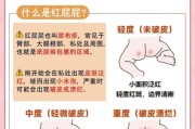 宝宝红屁股怎么处理_红屁股最快最有效的办法