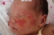 宝宝头上起湿疹怎么办_婴儿头皮湿疹怎么护理