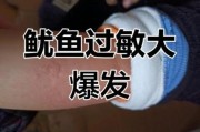 宝宝吃鱼过敏怎么办_宝宝吃鱼过敏症状
