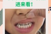 宝宝兜齿怎么办_兜齿几岁矫正最好