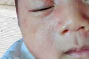 母乳会引起宝宝湿疹吗_湿疹宝宝还能继续母乳吗