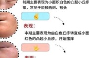 宝宝长痘痘有几种图片_新生儿痤疮和湿疹区别图