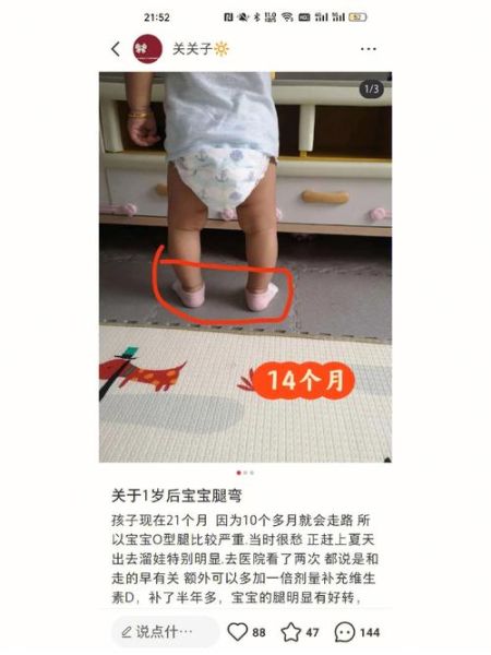 14个月宝宝o型腿图片_正常还是缺钙