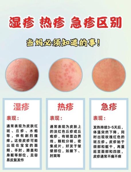 9个月宝宝出疹子怎么办_婴儿急疹护理方法