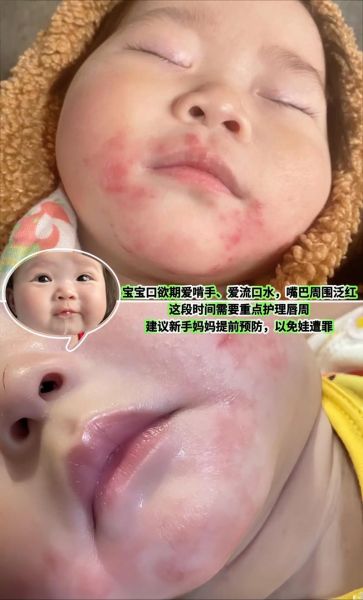 宝宝嘴上湿疹怎么办_宝宝嘴上湿疹小妙招