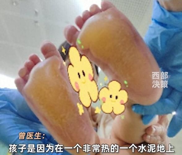 宝宝脚烫了怎么办_宝宝脚烫伤后如何护理