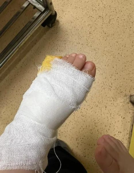 宝宝脚烫了怎么办_宝宝脚烫伤后如何护理