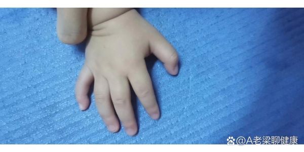 宝宝大拇指伸不直_需要看医生吗