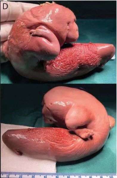 葡萄胎能生下宝宝吗_葡萄胎宝宝图片真实吗