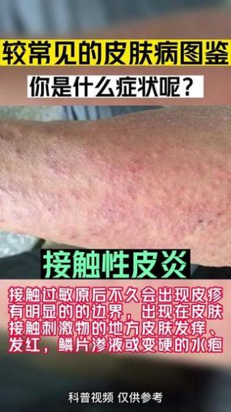 过敏图片大全_如何快速识别常见过敏症状