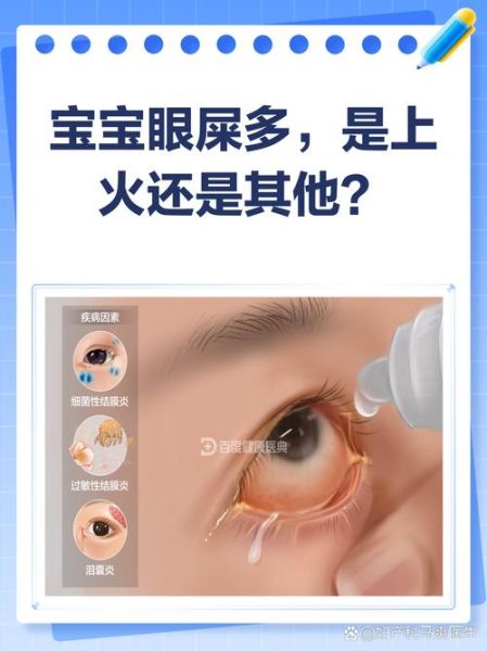 宝宝突然眼屎多怎么办_新生儿眼屎多正常吗