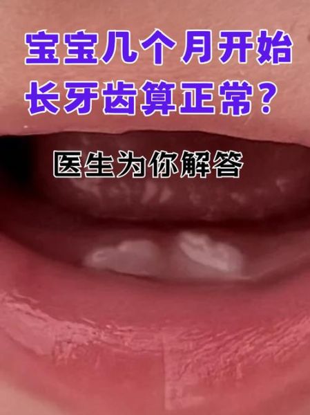 宝宝长牙慢怎么办_宝宝几个月长牙算晚