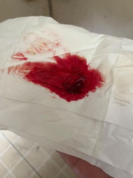 血图片大全_血图片有哪些类型