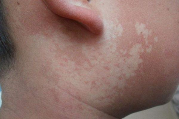 宝宝无色素痣会自己消失吗_宝宝无色素痣怎么治疗