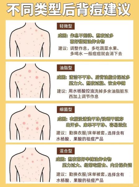 梦到长痘是什么意思_如何破解