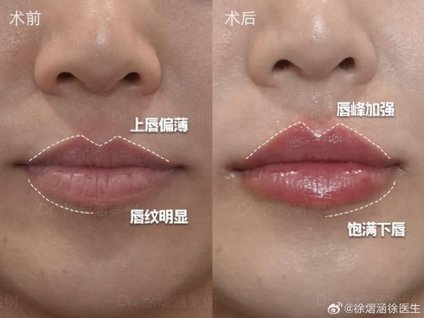 宝宝上嘴唇翘怎么矫正_婴儿翘唇纠正方法