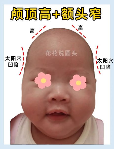 宝宝额头突出高正常吗_宝宝额头突出高图片对比
