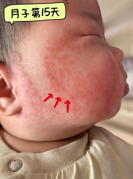 宝宝两边脸颊长小红点_怎么办
