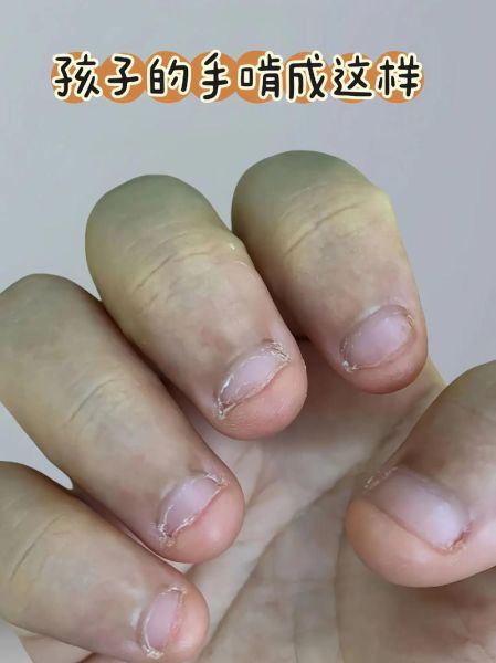 宝宝咬手指甲怎么回事_宝宝咬指甲缺什么