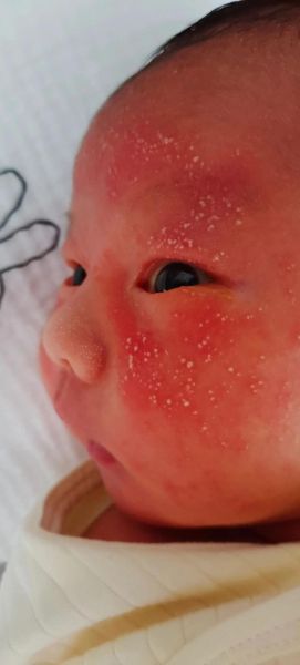 1岁半宝宝脸上长小红疙瘩怎么办_脸上小红疙瘩是什么