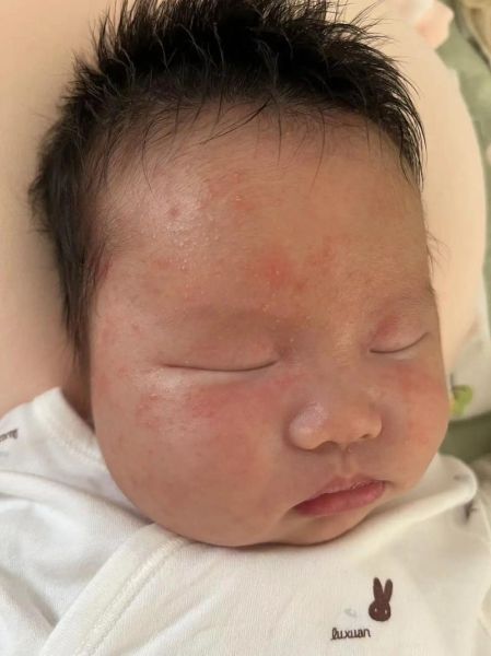 1岁半宝宝脸上长小红疙瘩怎么办_脸上小红疙瘩是什么