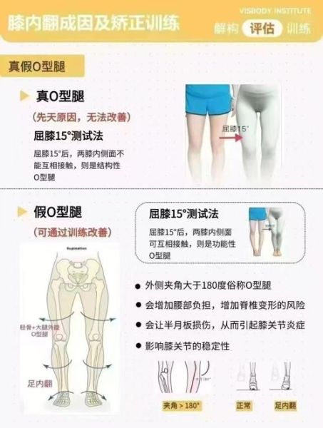 宝宝o型腿怎么矫正_婴儿罗圈腿矫正方法