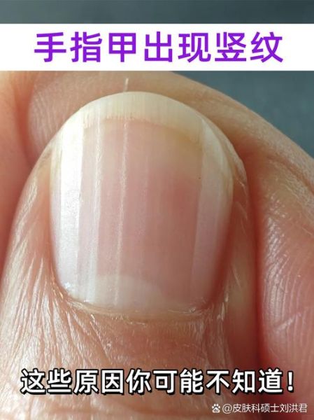 4个月宝宝指甲有竖纹正常吗_宝宝指甲竖纹缺什么