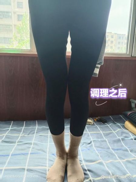 宝宝罗圈腿怎么办_罗圈腿矫正最佳时间