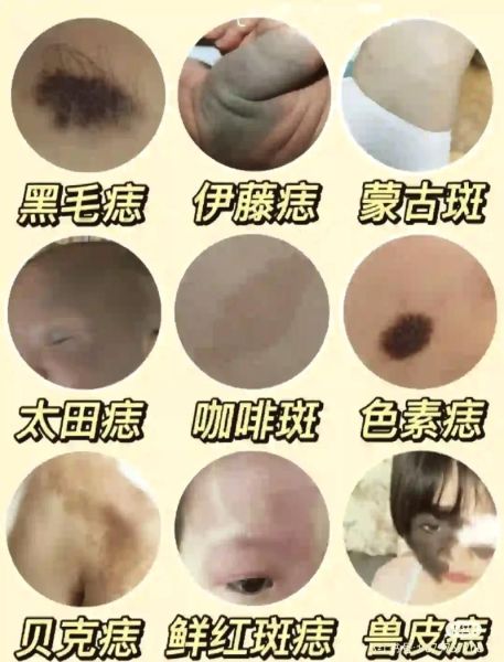 胎记图片大全_胎记类型有哪些