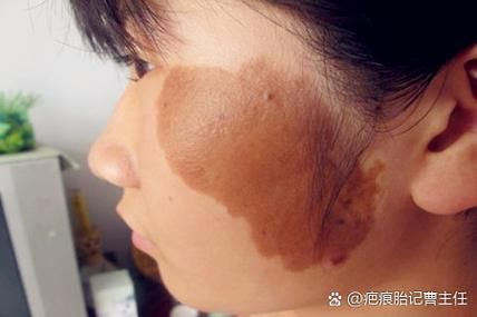 胎记图片大全_胎记类型有哪些