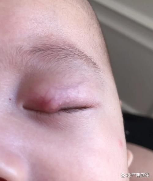 宝宝眼睛发炎怎么办_宝宝眼睛发炎图片怎么看