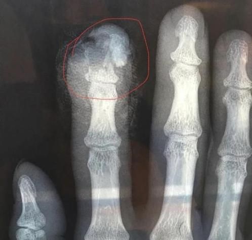 梦见自己骨折是什么意思_骨折梦境预示什么