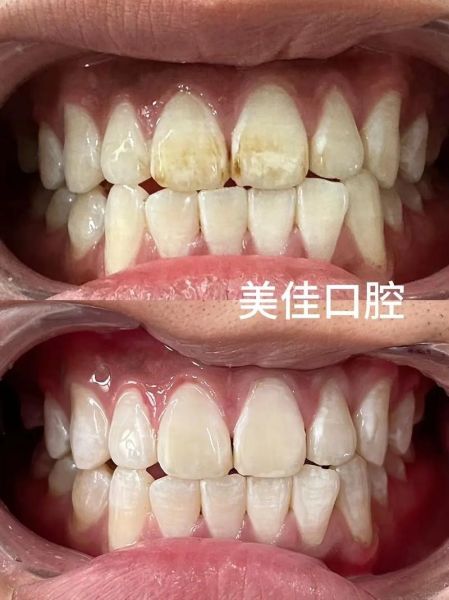 美牙图片大全_美牙前后对比真实案例