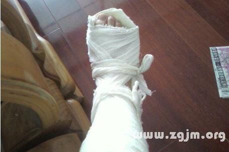 梦到腿骨折是什么意思_梦见腿断了预示什么