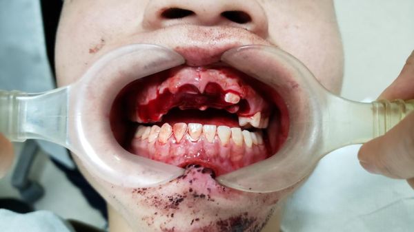 梦到掉了三颗牙齿_周公解梦与心理暗示