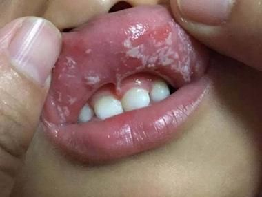 宝宝口腔溃疡图片_怎么快速缓解
