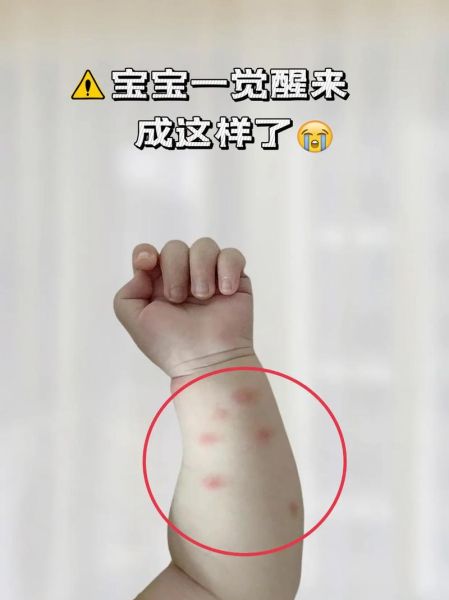 宝宝手被蚊子咬肿了怎么办_婴儿蚊虫叮咬快速消肿方法