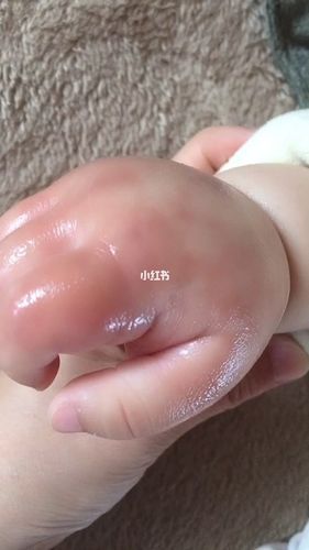 宝宝手被蚊子咬肿了怎么办_婴儿蚊虫叮咬快速消肿方法