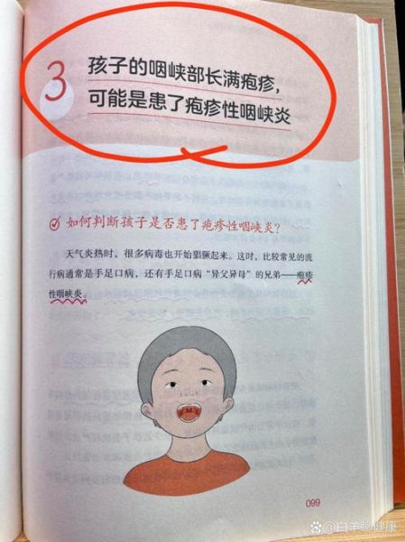 宝宝喉咙有疱疹怎么办_会传染吗