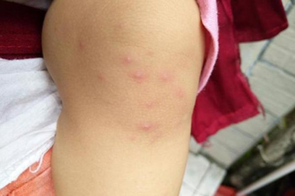 宝宝水痘早期症状图片_水痘初期红点照片